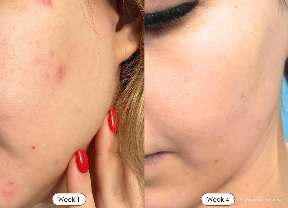 LightAura Plus LED face neck mask light therapy before and after results  showing reduced acne after 30 days