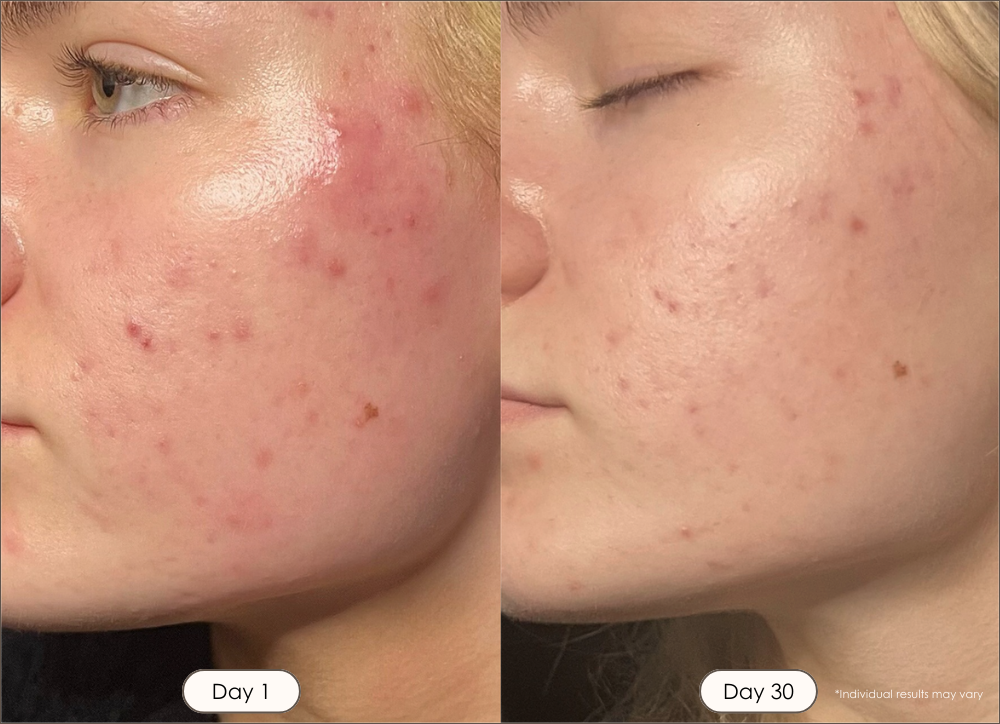 LightAura LED face mask before and after results showing improvement on mild acne and redness