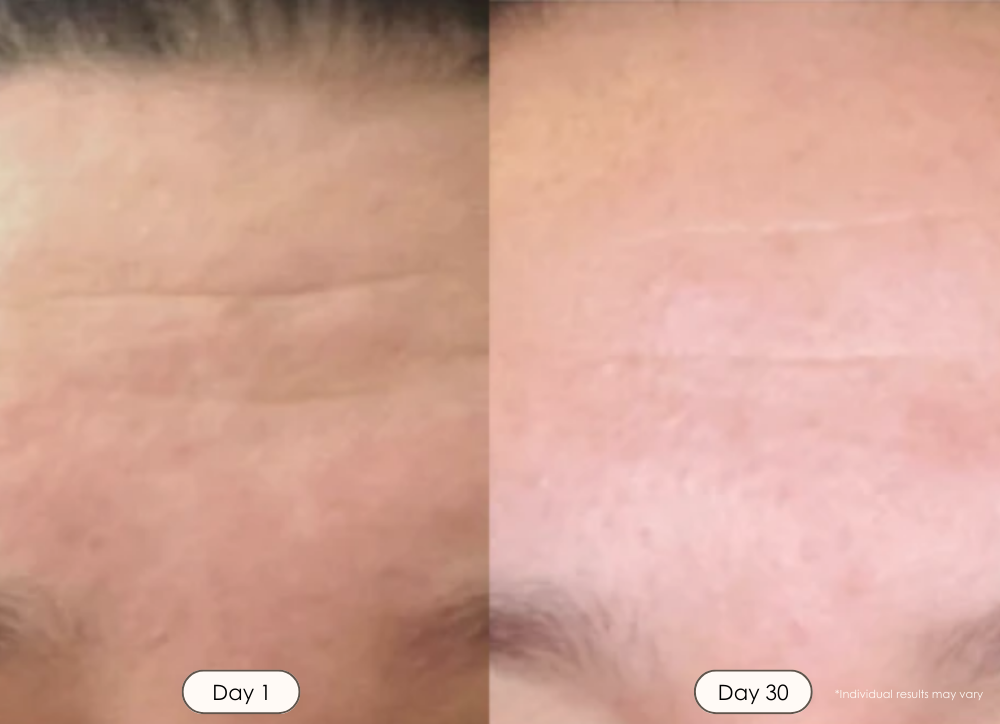 LightAura LED face light therapy mask before and after results showing reduced fine lines wrinkles