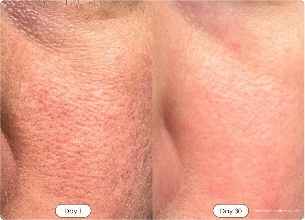 Faisca Neon High Frequency Wand before and after results showing smaller pores and smoother skin